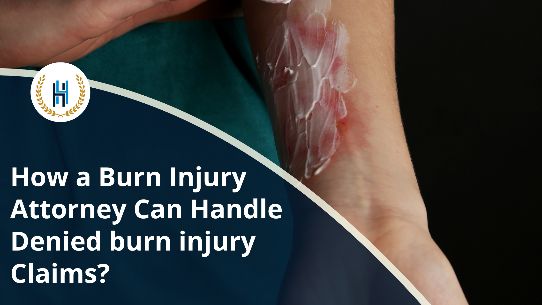 How a Burn Injury Attorney Can Handle Denied burn injury Claims | 2H Law